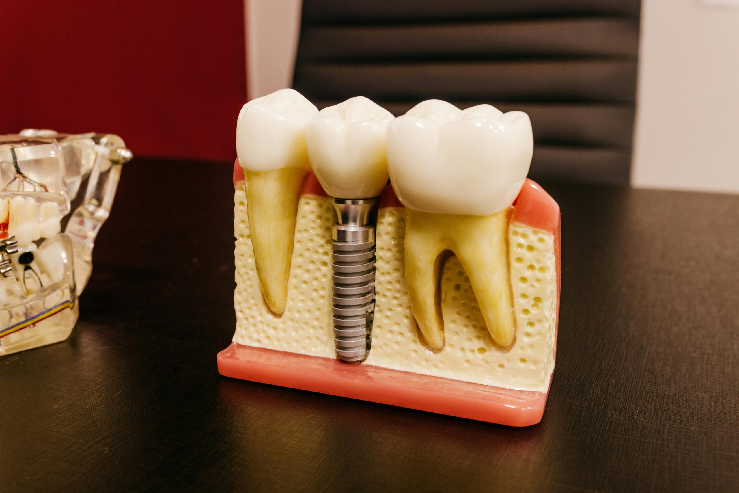 guide to dental implants
